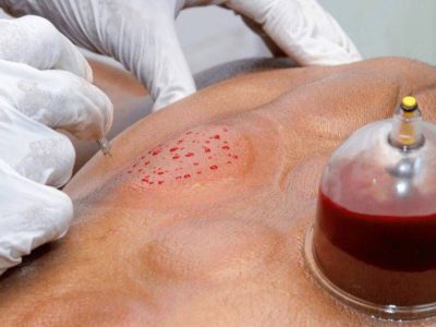 حجامت باید با تشخیص متخصص انجام شود